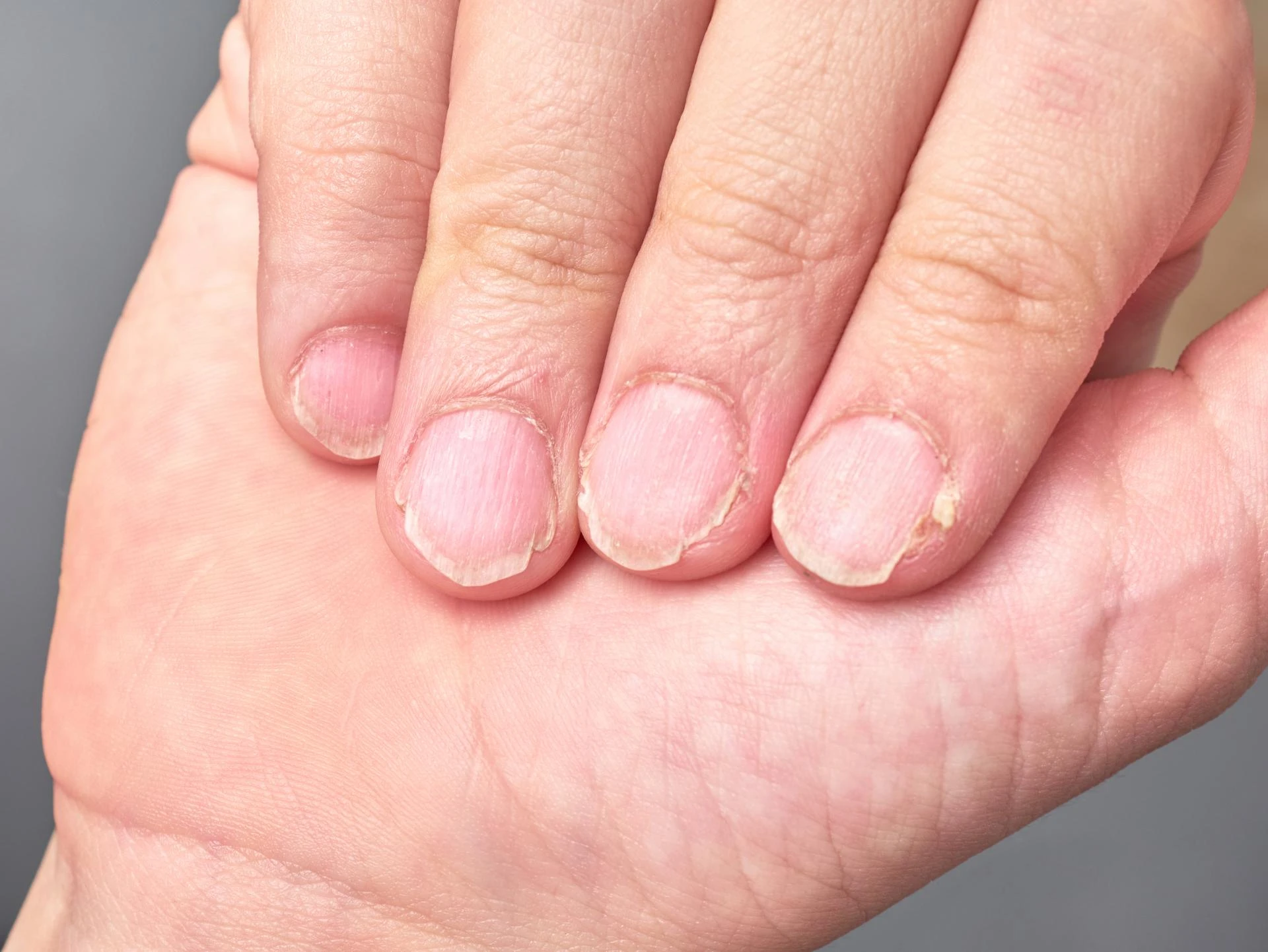 Nail Pigmentation Disorders